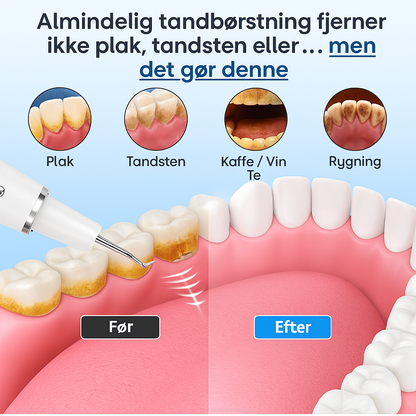 Ultralyd Tandrenser